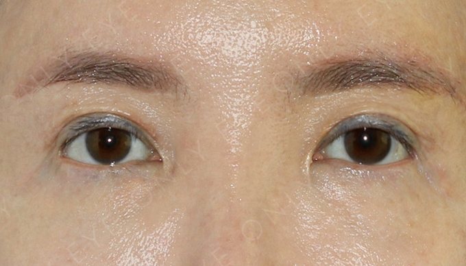 소시지 눈 교정, 눈썹하거상술 수술 후 3개월