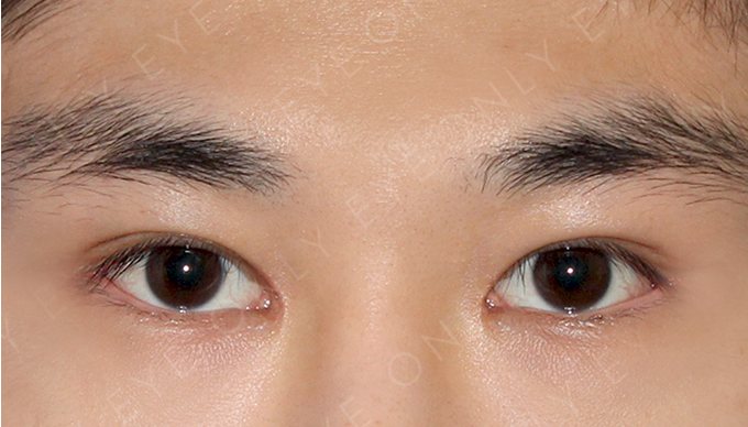 앞트임 흉터 복원 수술 후 1개월