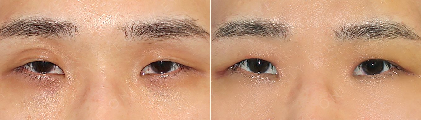 눈매교정 재수술 전후 (수술 후 1개월)