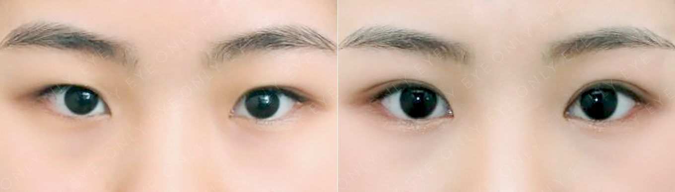 재수술 전후 (수술 후 2개월)