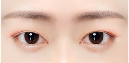 쌍꺼풀 라인이 너무 낮은 눈