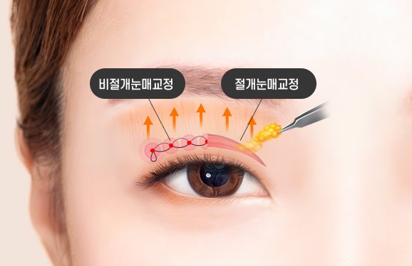 눈매교정 도식(비절개눈매교정·절개눈매교정)