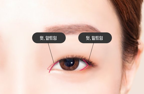 트임성형 도식(윗, 앞트임·뒷, 밑트임)
