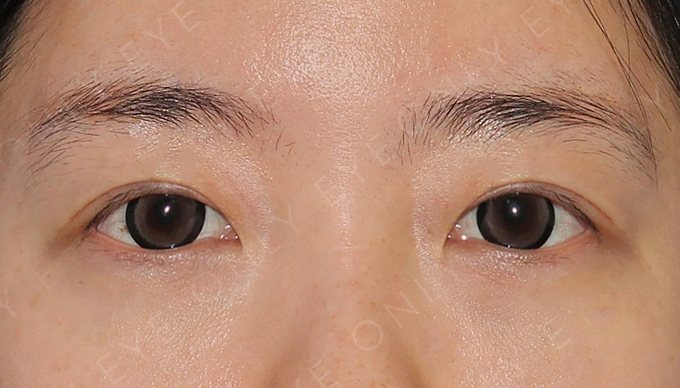 하이폴드 교정 수술 후 1년