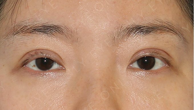 하이폴드 교정 수술 전
