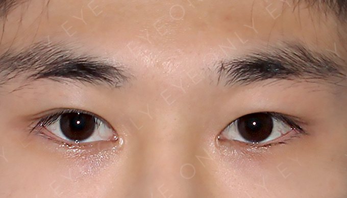 앞트임 흉터 복원 수술 전