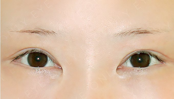 절개 쌍꺼풀 수술 후 4개월