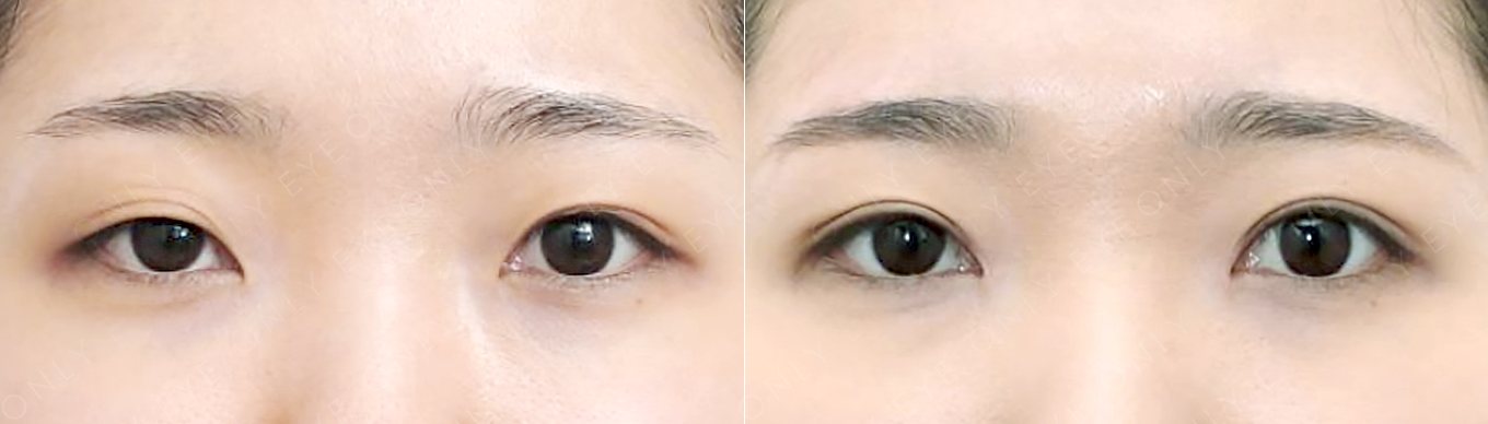 눈재수술 전후 (수술 후 3개월)