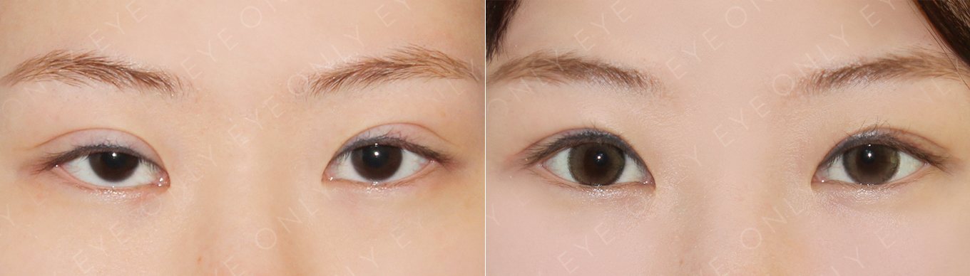 하안검,눈밑지방재배치,재수술 전후 (수술 후 2주)