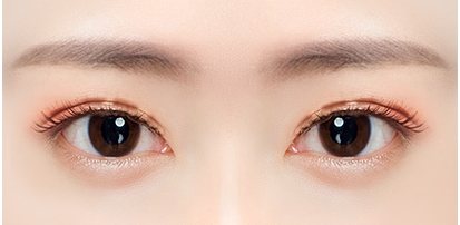 쌍꺼풀의 흉터가 심한 눈