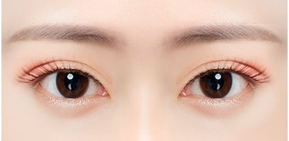 쌍꺼풀 라인이 너무 높은 눈