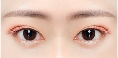 기존 수술의 결과가 불만족스러운 눈