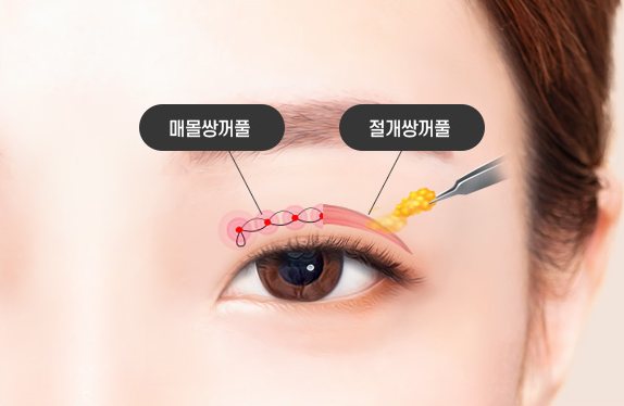 쌍꺼풀 수술 도식(매몰쌍꺼풀·절개쌍꺼풀)